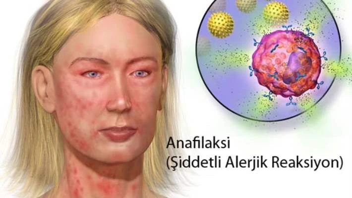 Alerji Nedir? Alerjen Nedir? Solunum Yolları Alerjilerinin Sebepleri Nelerdir?