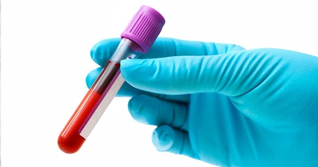 Aspartat Aminotransferaz (AST) Nedir? AST Yüksekliği Ve Düşüklüğü Ne Anlama Gelir?