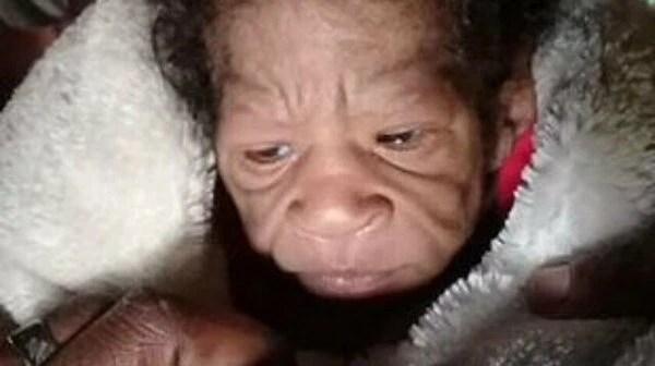 'Benjamin Button' filmi gerçek oldu: Yaşlı doğdu