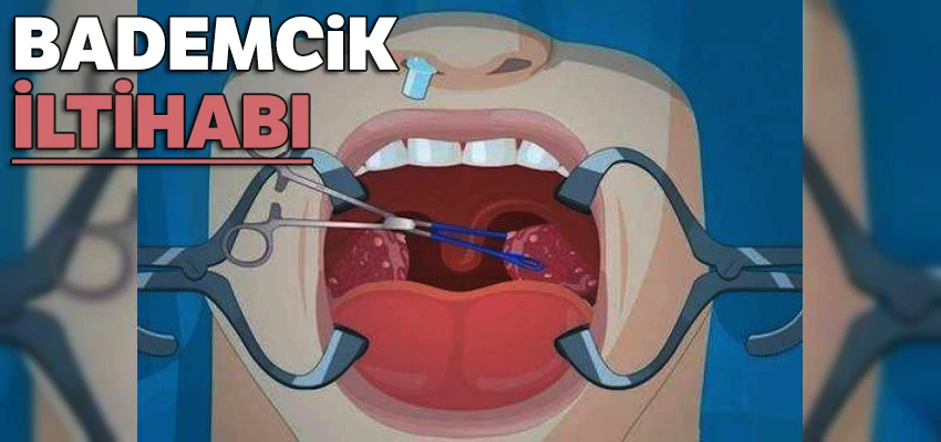 Kriptik Tonsillit, Bademcik İltihabı Nedir Nasıl Geçer