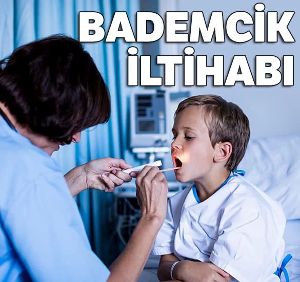Kriptik Tonsillit, Bademcik İltihabı Nedir Nasıl Geçer