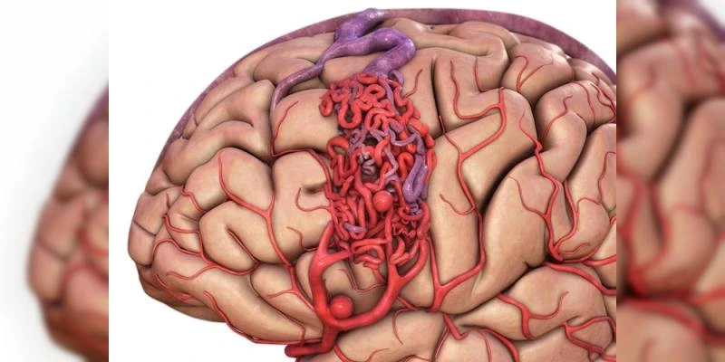 Beyin Kanaması Nedir? Beyin Kanaması Neden Olur?