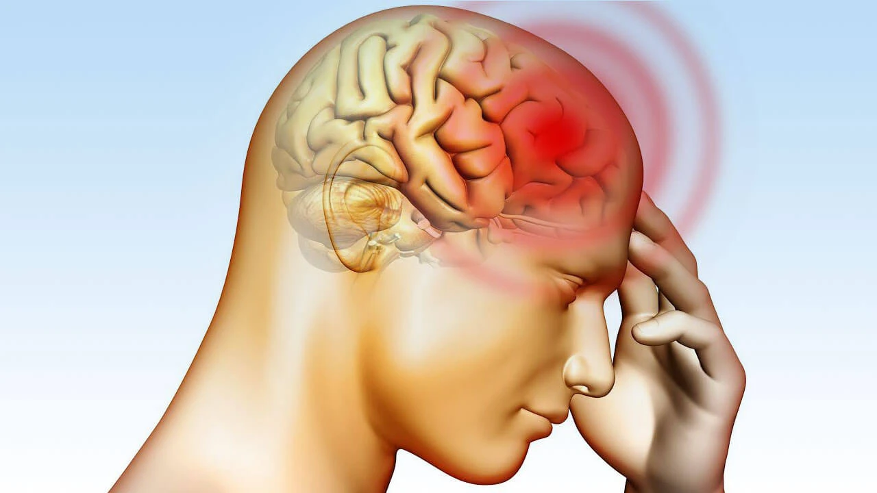 Beyin Kanaması (Anevrizma) Nedir Beyin Kanaması Öldürür mü