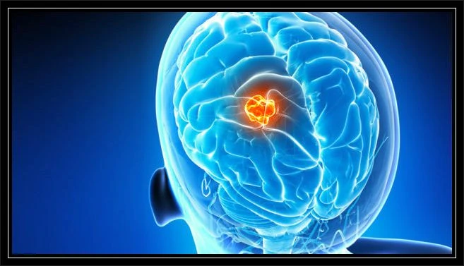 Beyin tümörü hastaları ne kadar yaşar,  Beyin tümörü neden olur?