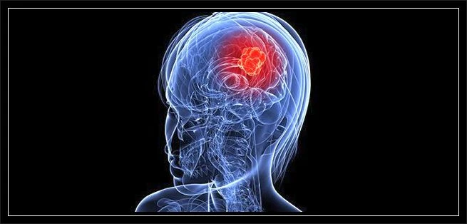 Beyin tümörü hastaları ne kadar yaşar,  Beyin tümörü neden olur?