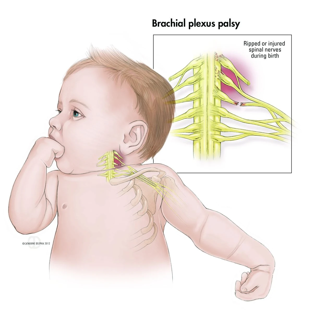Brakial Pleksus Hasarında Klinik Bulgular Nelerdir?