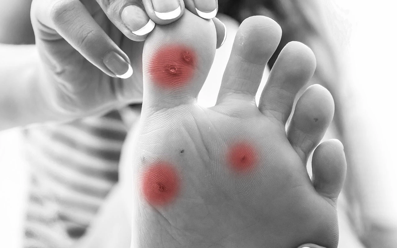 Buerger Hastalığı Belirtileri