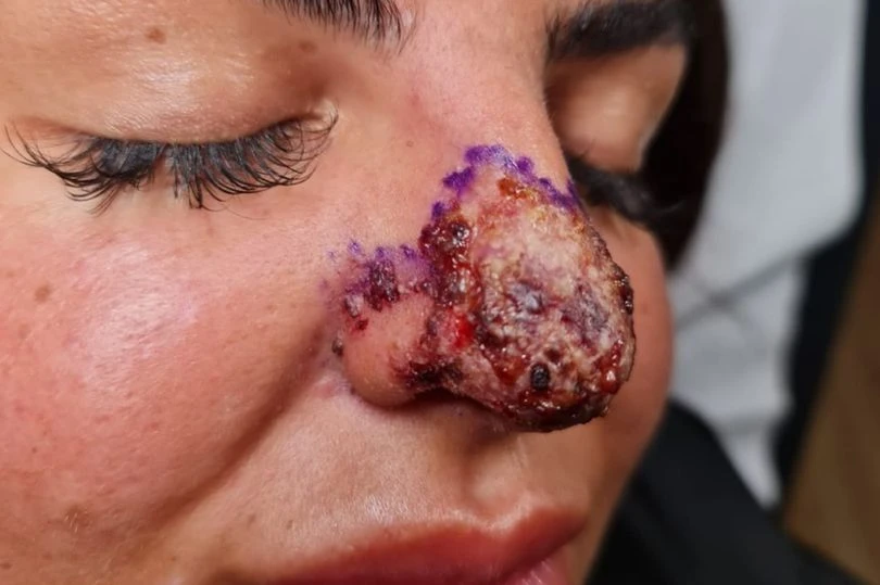 Burun dolgusuyla beraber et yiyen bakteri de enjekte edildi kabusu yaşadı