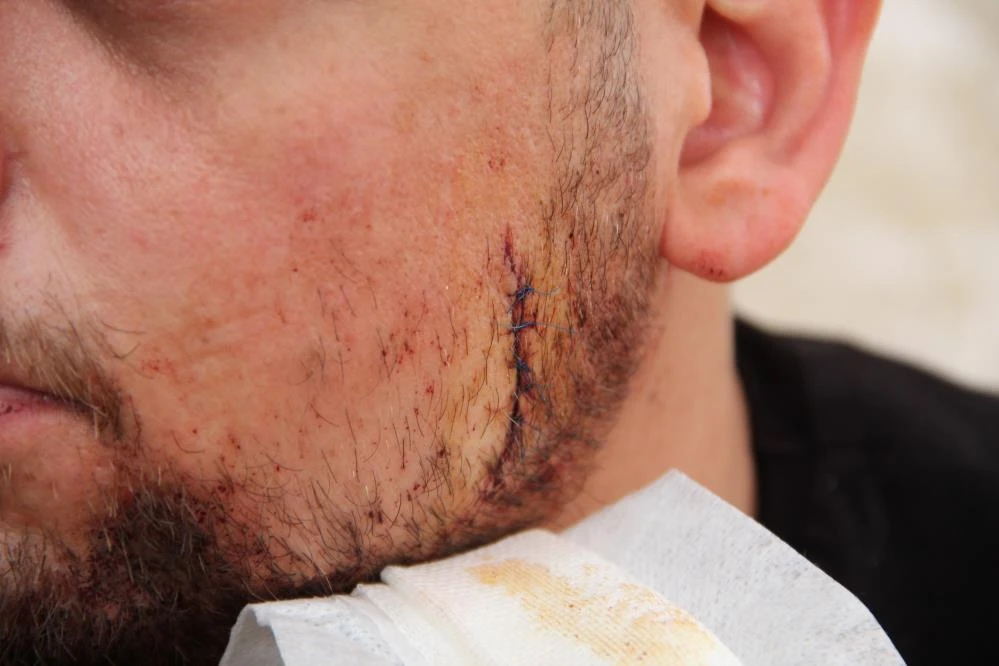 Kadına tokat attı diye uyardı, çatalla yüzünden yaralandı