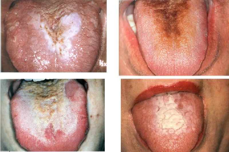 Dilde Sivilce Neden Çıkar? / Dilde Çıkan Sivilce Nasıl Geçer? / Dilde Çıkan Sivilceye Doğal Tedavi Yöntemleri Nelerdir?