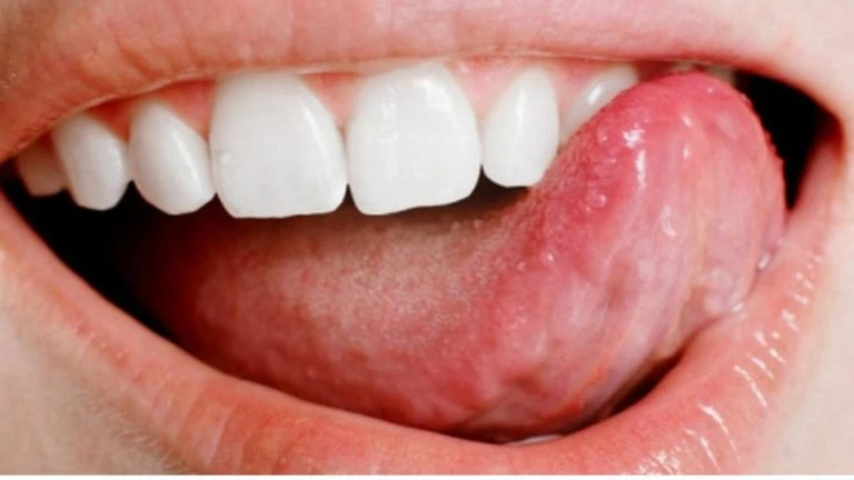 Dil hastalık ve yaraları nedir?/ Dil acıması neden olur?