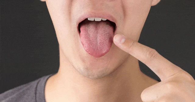 Kıllı Dil Hastalığı Nedir, Nasıl Oluşur? Kıllı Dil Hastalığı Tedavi Yöntemleri