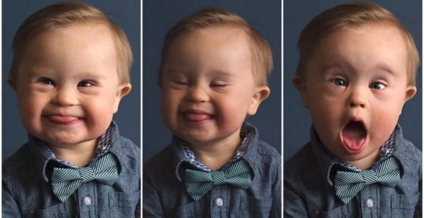 Down Sendromu Nedir? Down Sendromu Nasıl Anlaşılır? Down Sendromu Çocuklarda Nasıl Olur?