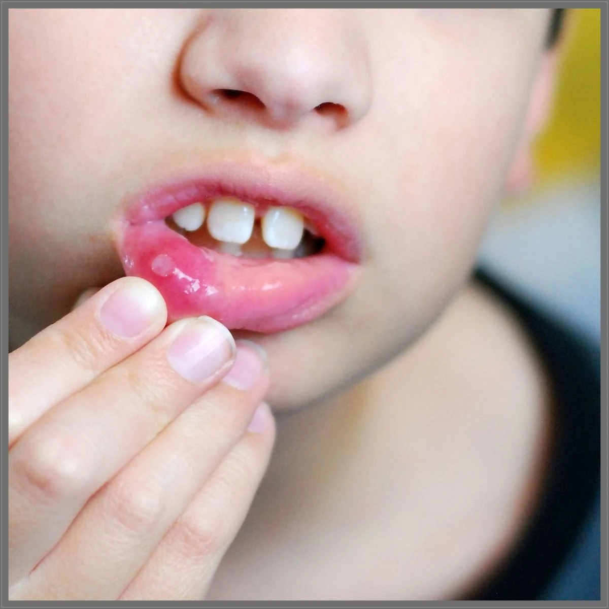 Uçuk neden olur Neden çıkar ve Nasıl Geçer, Uçuğa Ne İyi gelir, Uçuğa Diş Macunu iyi gelir mi?