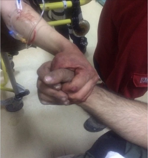 Afrin'de yaralanan iki askerin fotoğrafı yürek dağladı