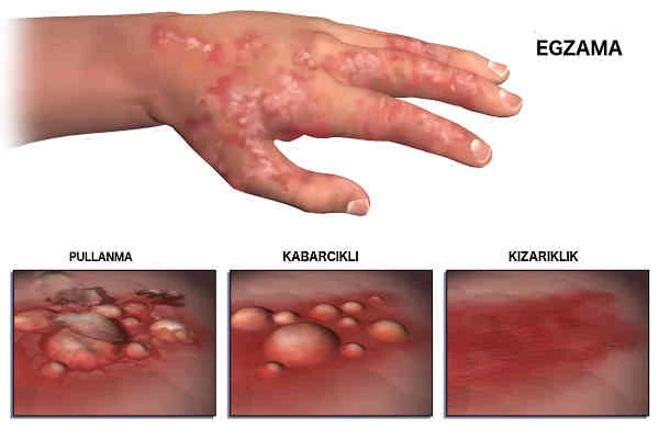 Egzama nedir neden olur tedavisi var mı? Egzama belirtileri nelerdir bulaşıcımıdır?