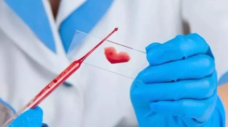 Orak Hücreli Anemi Nedir?