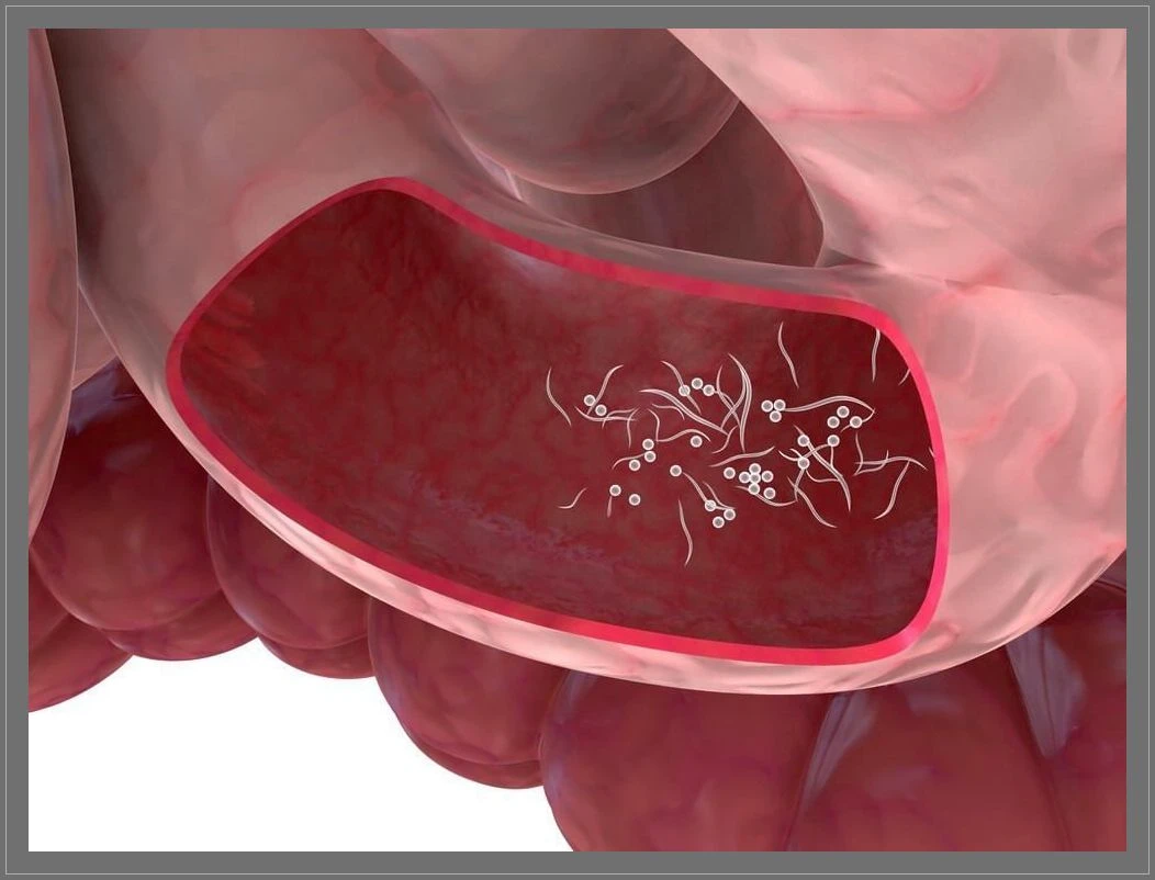 Kıl kurdu Tedavisine Sirke ve Sarımsak İyi Gelir Mi?