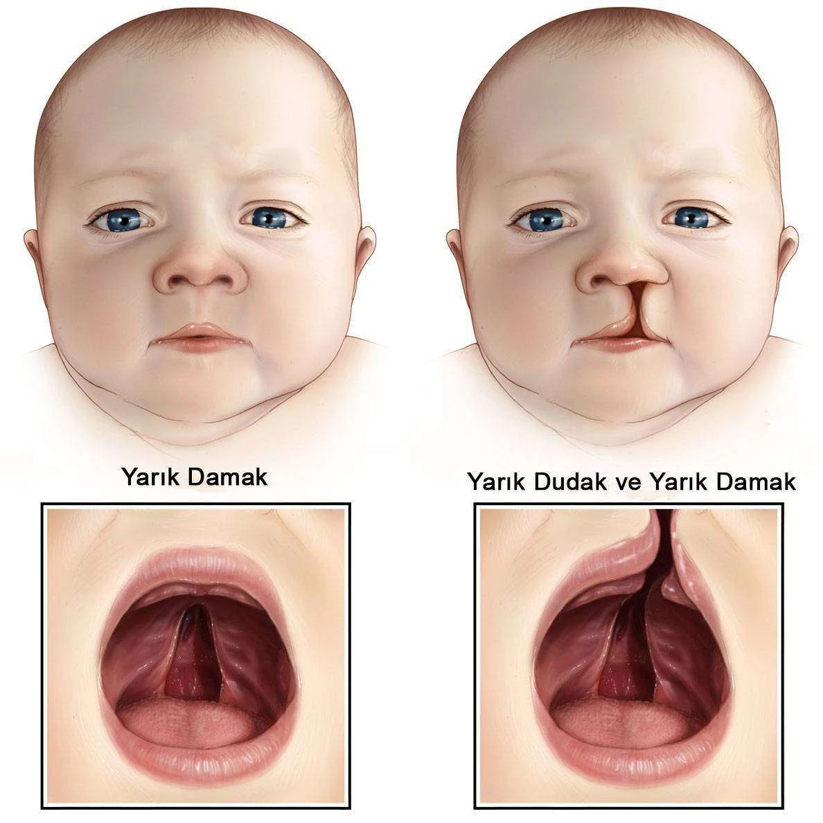 Yarık Damak ve Dudak Bebeklerde Yarık Dudak Ultrasonda Belli Olur mu?