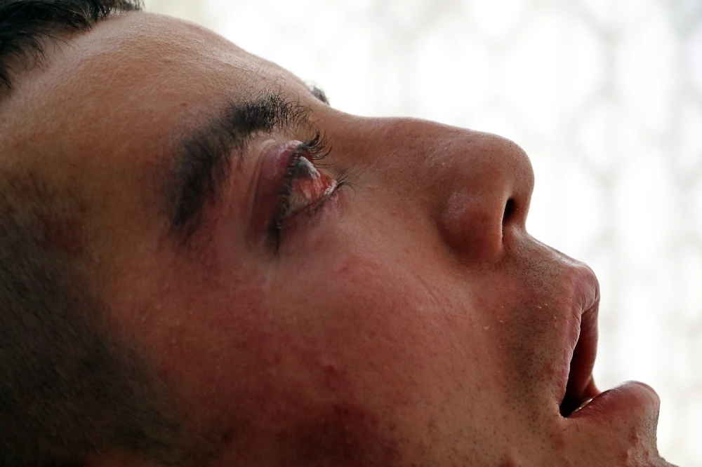 5 yıldır gözlerini kırpamıyor