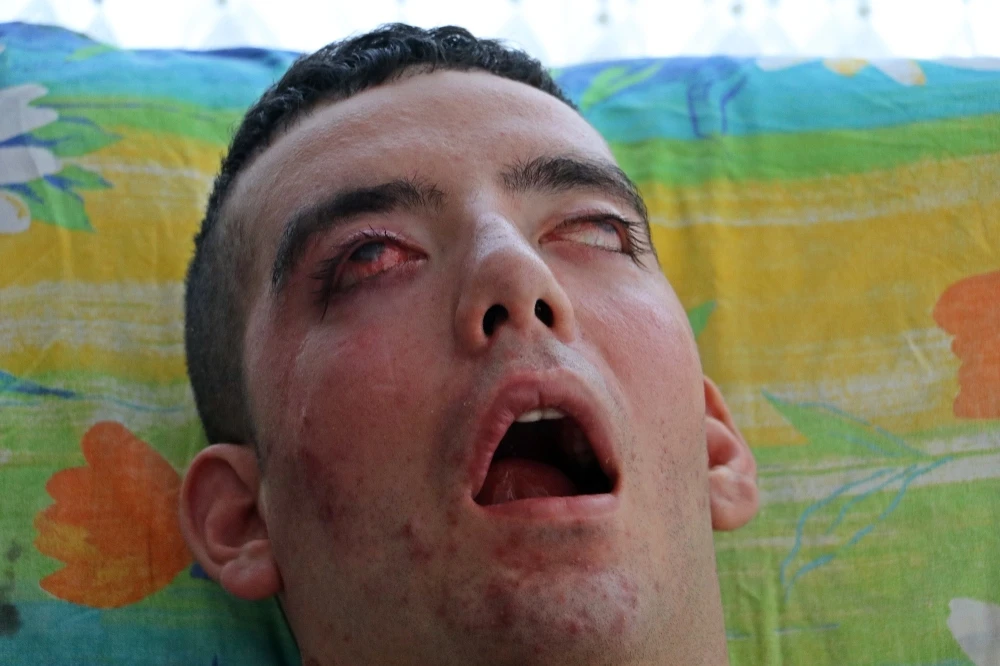 5 yıldır gözlerini kırpamıyor