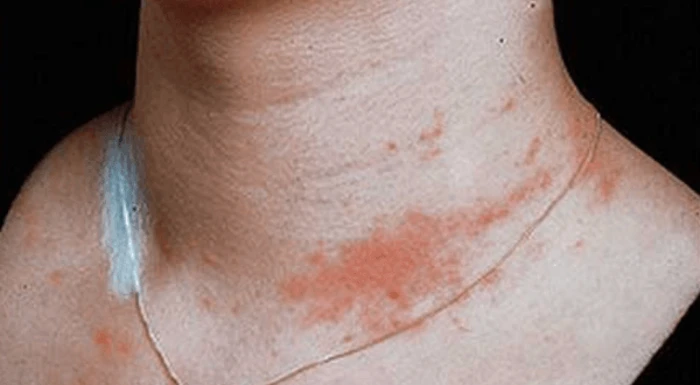 İlaç alerjisi nedir? İlaç alerjisi kaç günde geçer?