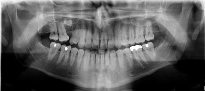 Panoramik diş filmi nedir? Diş röntgeni nasıl okunur?