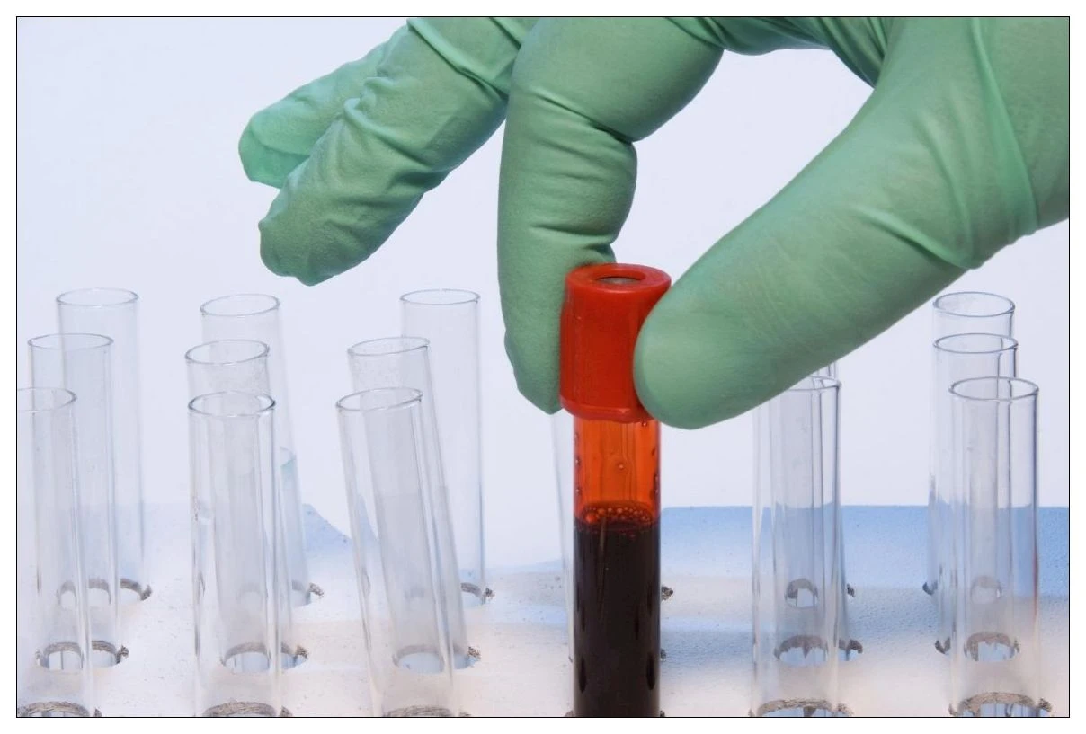 Kanda UİBC Nedir? UİBC Düşüklüğü, Yüksekliği Ve Normal Değerleri Nasıldır?