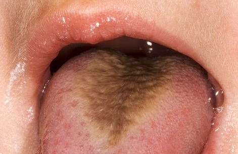 Kıllı Dil Hastalığı Nedir, Nasıl Oluşur? Kıllı Dil Hastalığı Tedavi Yöntemleri