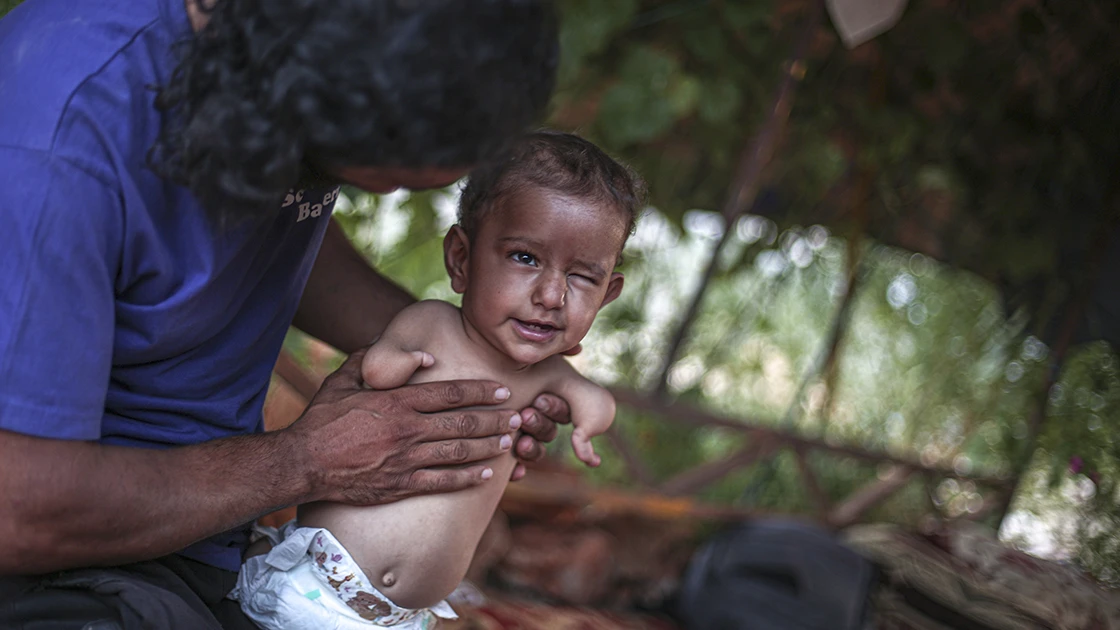 Uzuvları olmayan Muhammed bebek tutunacak bir hayat arıyor