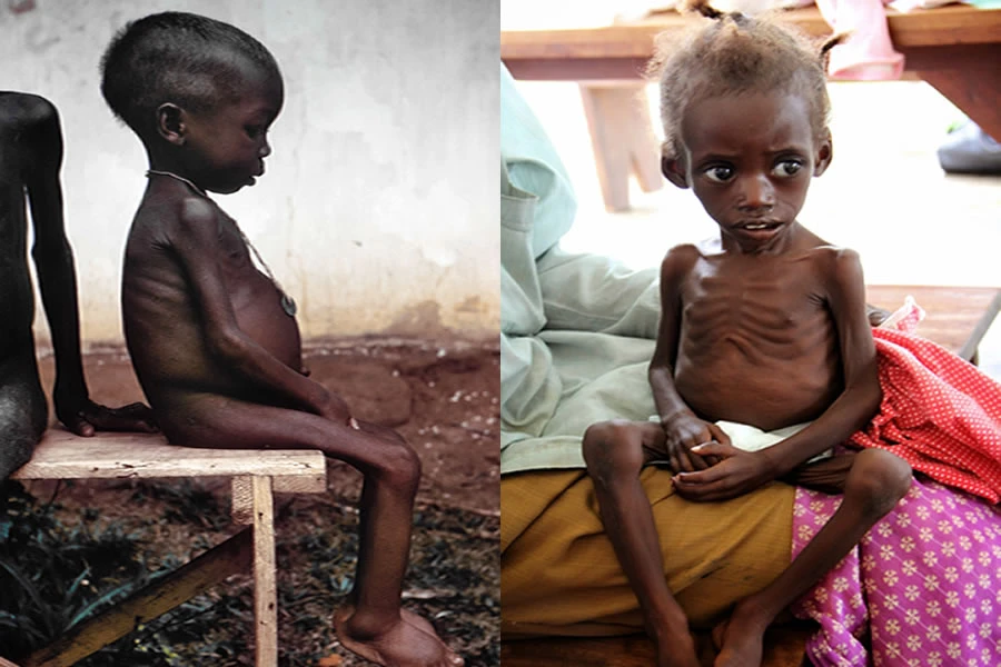 Malnütrisyon tanımı ne demek? Malnütrisyon belirtileri nelerdir? Malnütrisyon tipleri nelerdir?