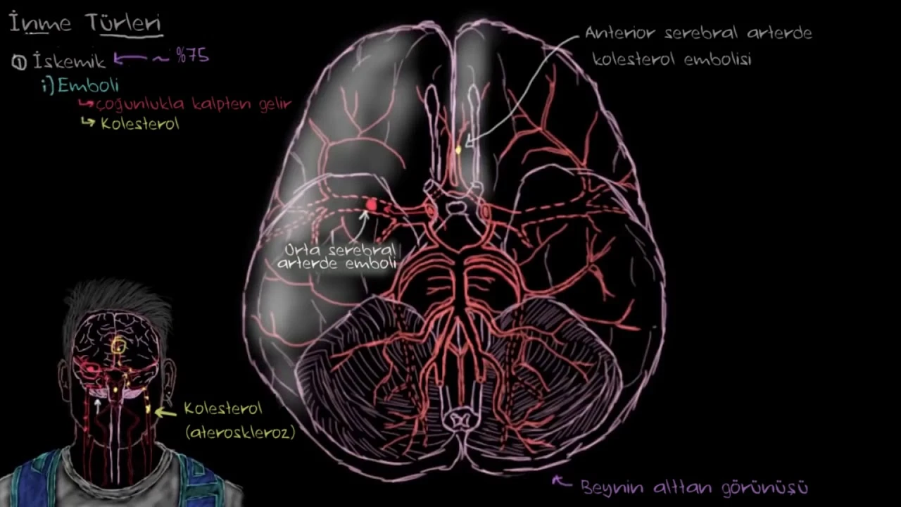 Beyin İskemisi Nedir? Beyinde Kronik İskemik Nedir?