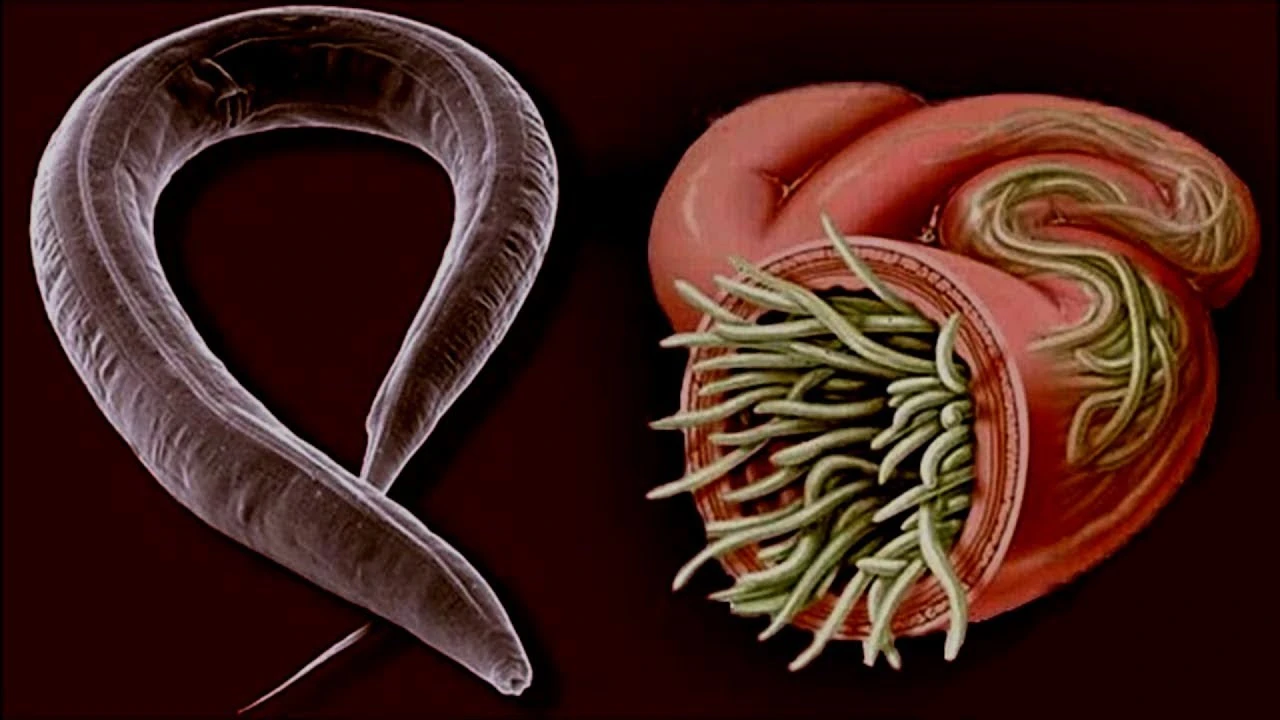 Kancalı Kurt Enfeksiyonu, Bağırsak Kurdu Nasıl Düşürülür?