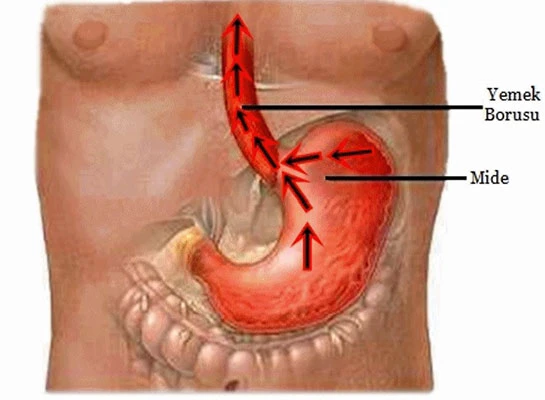 Yemek Borusunda Yanma, Yemek Borusu Yanması, Yemek Borusu Yanma Nedenleri ve Tedavisi
