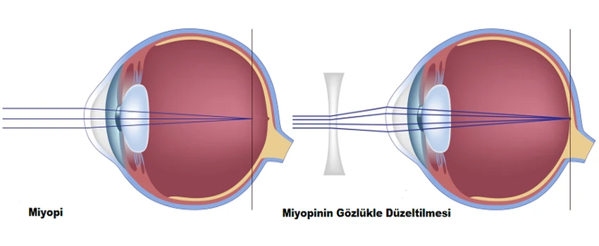 Miyopi Nedir? Belirtileri Nelerdir? Miyopi İçin Öneriler
