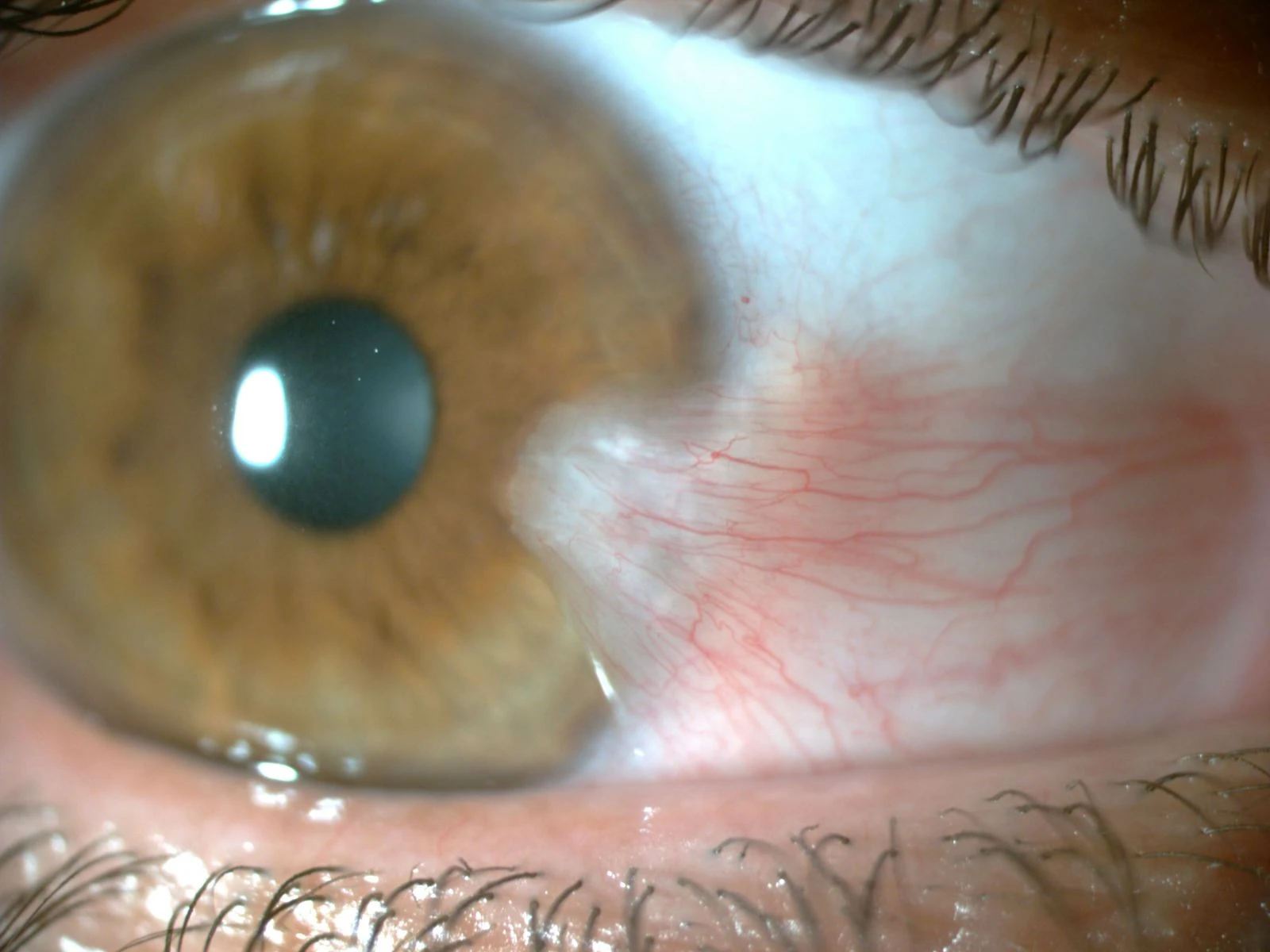 İris İltihabı (İritis) Göz Romatizması Nedir Neden Olur?