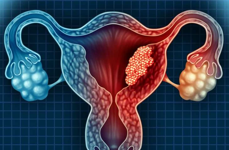 Histerektomi Nedir? Rahim Alınması Ameliyatı