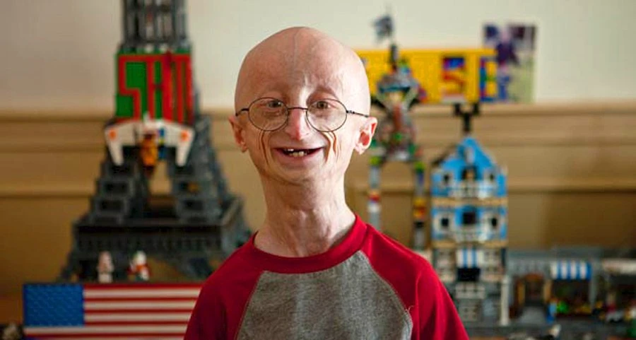 Harlequin Tipi İktiyozis (Palyaço Bebek Hastalığı) Nedir? Neden Olur?