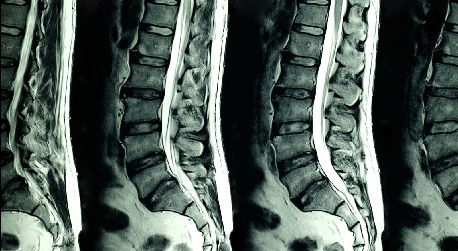 Dejeneratif Disk Hastalığı Tedavisi