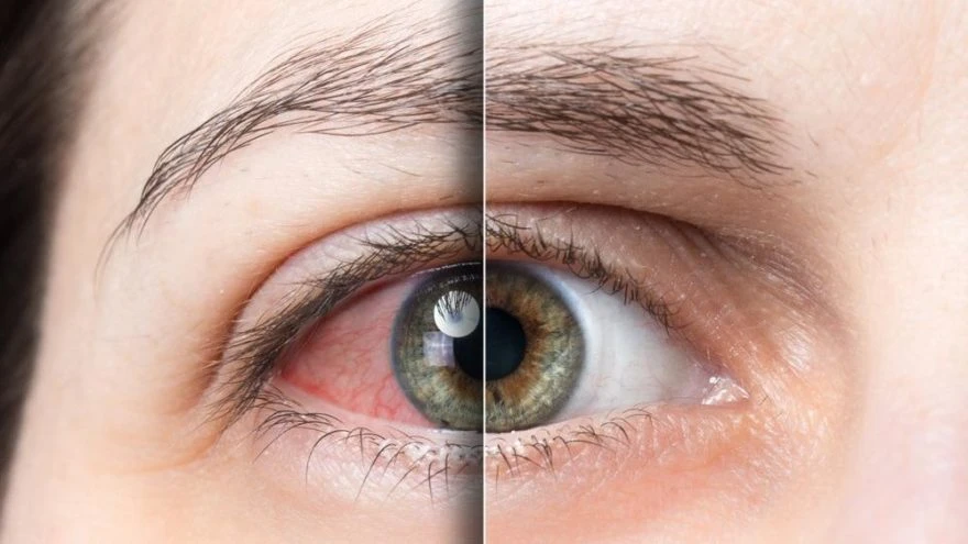 Kolobom Ne Demek, Doğuştan İris Kolobomu Nedir?