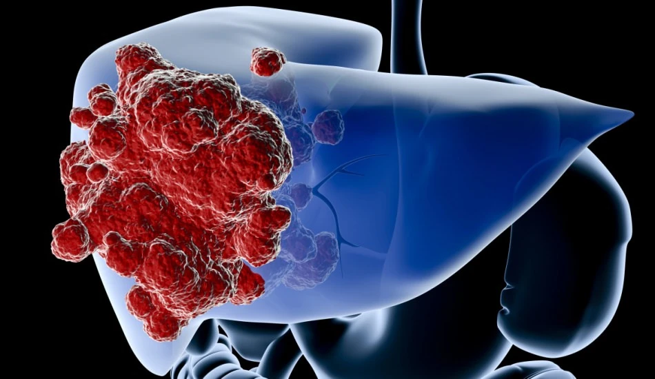 Primer Biliyer Siroz (PBS) Ne demektir? Primer biliyer siroz belirtileri nelerdir?