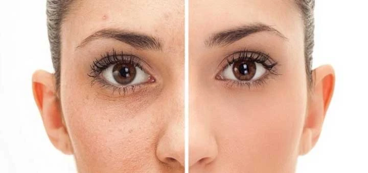 Yüze Bal Sürmek Faydalı Mı? Balın Cilde Faydaları Nelerdir? Bal Tüy Çıkartır mı?