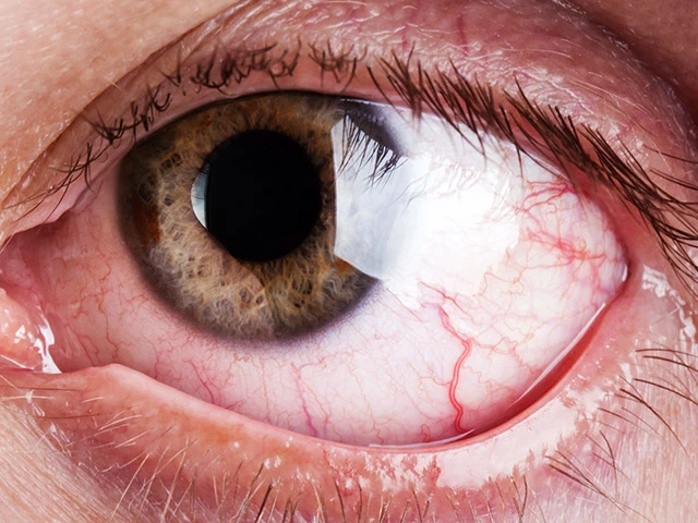 Sjögren Sendromu Nedir?