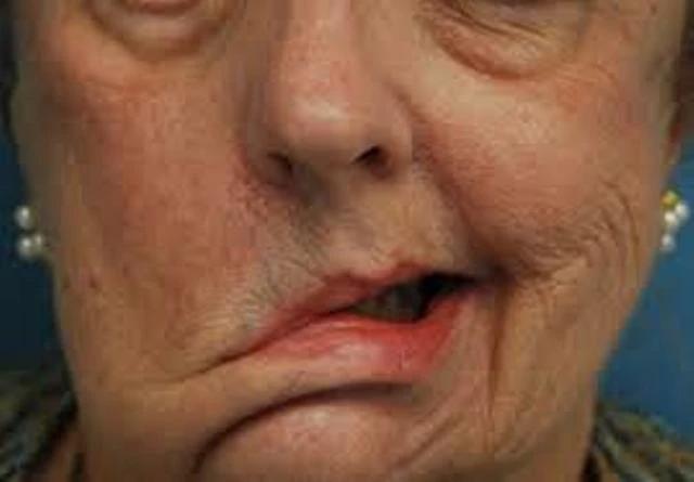 Yüz Felci Nedir? Yüz Felci Neden Olur? Yüz Felci Nasıl Tedavi Edilir?