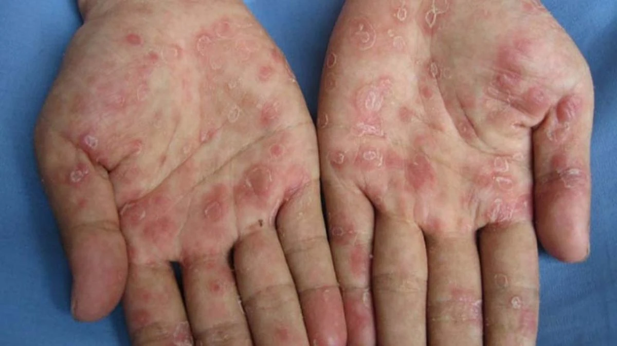 Erkeklerde Cinsel Yolla Bulaşan Hastalıklar Nelerdir? Klamidya Nedir? Klamidya Sadece Cinsel Yolla mı Bulaşır?