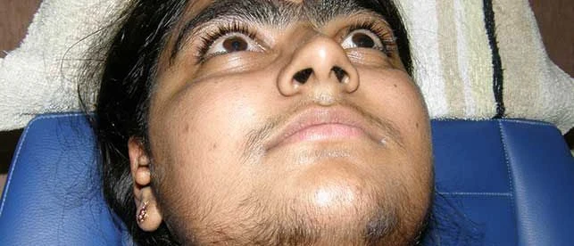 Polikistik Over Sendromu (PCOS) ve Hirşutizm (Kadınlarda Kıllanma)