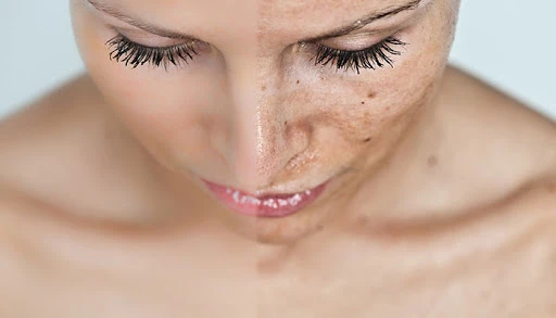 Oksijen terapi nedir? Oksijenli cilt bakımı nasıl yapılır? 