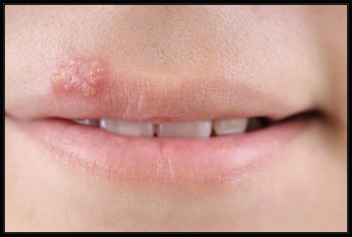 Uçuk neden olur Neden çıkar ve Nasıl Geçer, Uçuğa Ne İyi gelir, Uçuğa Diş Macunu iyi gelir mi?