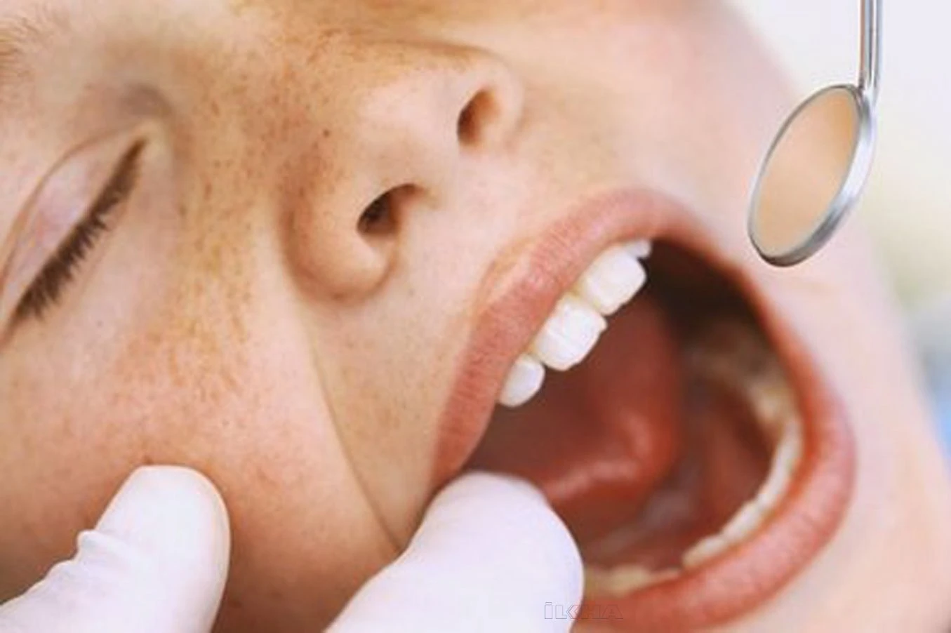 Bademcik Şişmesi Nasıl Geçer Evde? Farenjit - Boğaz İltihabı Nedir?