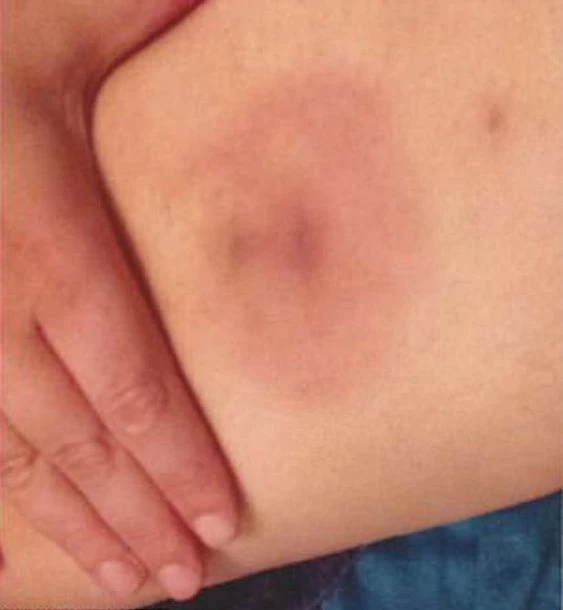 Kasığındaki çıban hayatını mahvetti